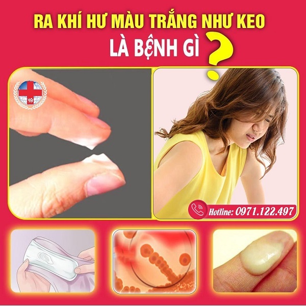 Khí Hư Màu Trắng Dính Như Keo Là Bệnh Gì?