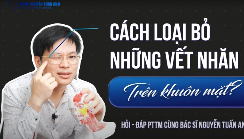 Tiêm botox giảm nếp nhăn