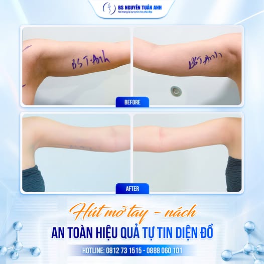 Hút Mỡ Tay Nách – Giải Pháp Cho Vùng Cánh Thon Gọn