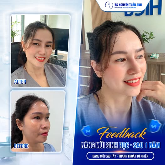 Nâng mũi sinh học: Giải pháp cho diện mạo thanh thoát và tự tin hơn