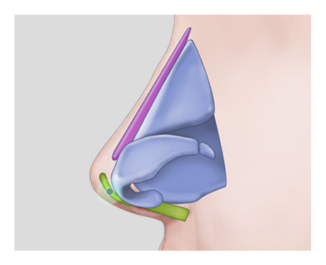 Mũi lộ sóng sau phẫu thì cần sử dụng phương pháp nào?
