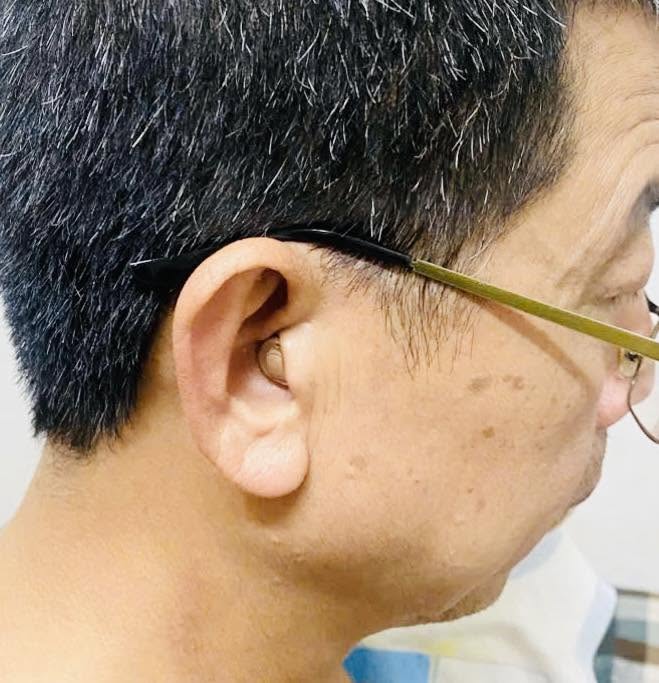 Lắp đặt máy trong tai thẩm mỹ cho bác khách ở Văn Giang – Hưng yên
