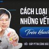 Tiêm botox giảm nếp nhăn