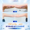 Hút Mỡ Tay Nách – Giải Pháp Cho Vùng Cánh Thon Gọn