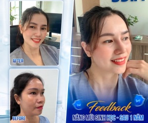 Nâng mũi sinh học: Giải pháp cho diện mạo thanh thoát và tự tin hơn