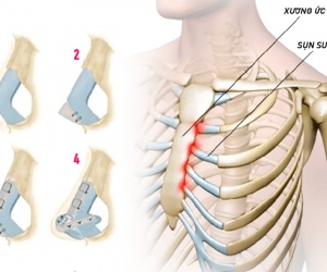 Nâng mũi sụn sườn có đảm bảo an toàn tuyệt đối không?